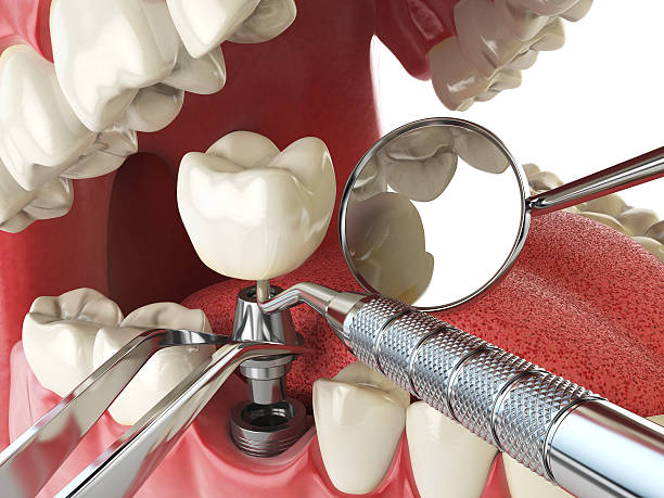 Best Emergency Dentist for Knocked-Out Tooth in Lowesville, NC